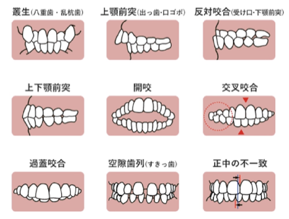 悪い歯並び（不正咬合）の種類